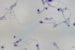 El coronavirus SARS-CoV-2 puede causar daño y atrofia testicular Coronavirus puede atrofiar los testículos