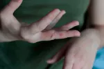 Síntomas de la sarna Síntomas de la sarna o escabiosis