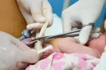 Medicos cortando el cordón umbilical entre un recién nacido y la placenta
