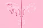 Endometriosis, cómo afecta a tus posibilidades de embarazo Endometriosis