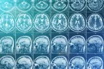 Identifican 75 factores de riesgo de alzhéimer que aclaran sus causas Alzhéimer: gran hallazgo sobre su origen