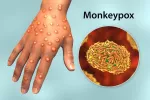 Ampollas causadas por el Monkeybox en una mano Ampollas en la mano características del contagio por viruela del mono