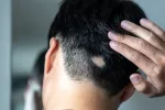 Nuevo fármaco eficaz con la alopecia areata