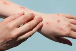La viruela del mono podría llevar tiempo circulando sin ser detectada Manos con síntomas de viruela del mono