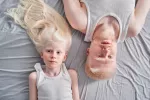 Consecuencias de ser albino