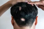 Primer fármaco para alopecia severa