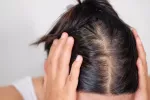 Pérdida de cabello y falta de libido, nuevos síntomas posCOVID Pérdida pelo, síntomas posCOVID