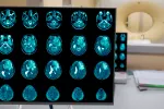 Nuevo fármaco eficaz contra glioblastoma