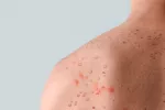 La AEDV publica nuevos signos dermatológicos de la viruela del mono Viruela del mono: nuevos signos en piel