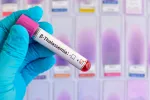 La FDA aprueba la primera terapia génica para tratar la beta-talasemia Muestra sanguínea con beta-talasemia