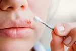 Virus herpes usado para combatir cáncer