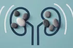 Ultrasonidos pueden eliminar cálculos renales sin dolor ni anestesia Así logran eliminar cálculos sin dolor