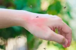 Sanidad identifica dos casos de dengue autóctono en Ibiza Mosquitos picando en la mano a una persona