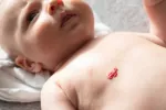 Bebé con un hemangioma en el pecho