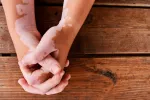 Una mujer con vitiligo en las manos