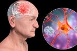 Ilustración 3D de una persona de edad avanzada con deterioro cerebral