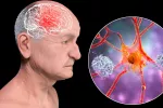 Detectan clave para predecir si un adulto sano desarrollará alzhéimer Ilustración 3D de una persona de edad avanzada con deterioro cerebral