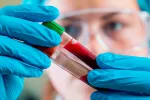 Un test de sangre detecta más de 50 tipos de cáncer con gran precisión Análisis en el laboratorio de una muestra de sangre