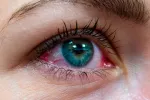 Ojos rojos: causas del enrojecimiento ocular y cómo evitarlo Chica con los ojos rojos
