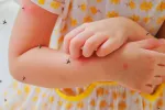 Niña que se rasca el brazo por los mosquitos