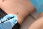 Dermatólogo marca la piel de un paciente donde hay un melanoma