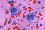 Ilustración de células de leucemia mieloide