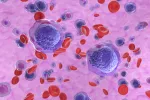Ilustración de células de leucemia mieloide