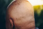 Científicos confirman el vínculo entre la calvicie y el cáncer de piel Persona calva