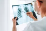España financiará nivolumab para el tratamiento del cáncer de pulmón Doctor observando una radiografía de pulmón