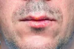 La infección por virus del herpes simple duplica el riesgo de demencia Un hombre con un herpes labial