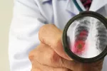 El coronavirus puede permanecer en el cuerpo más de un año tras infectarte Coronavirus SARS-CoV-2 en los pulmones de una persona infectada