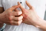 Persona con psoriasis en las manos