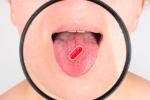 Lupa examinando una bacteria en la lengua de un paciente