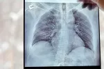 Desarrollan un fármaco que regenera tejido pulmonar dañado Médico sostiene una radiografía de los pulmones