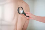 Descubren cómo los melanomas “rompen genes” para resistir ante la terapia Dermatólogo examinando manchas en la espalda de un paciente