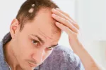 Nuevo tratamiento podría revertir la caída del cabello por alopecia areata Hombre joven observa en el espejo zonas sin cabello en su cabeza
