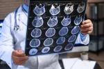 Terapia contra el alzhéimer resulta eficaz en su primer ensayo en humanos Médico estudia imágenes del cerebro