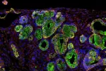 Tumor de páncreas al microoscopio Inmunofluorescencia de un tumor de páncreas