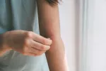 Tomar mucha sal aumenta el riesgo de desarrollar dermatitis atópica Chica rascándose el brazo lleno de heridas y cicatrices