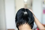 Un fármaco revolucionario para tratar alopecia areata llega a España Una mujer mostrando su alopecia en el cabello de la cabeza