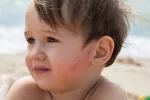 Alergólogos alertan del riesgo de reacciones alérgicas en niños en verano Niño con una alergia cutáne en la cara