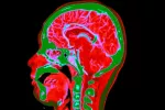 Aminoácido causa de cánceres de cabeza y cuello Angiografía del cáncer de cabeza y cuello