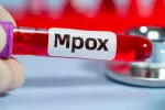 La OMS declara emergencia internacional por nueva cepa de mpox más grave se Sanitario sujeta muestra de sangre infectada por mpox