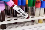 La UE considera bajo el riesgo de propagación de mpox Tubos de ensayo con muestras para hacer test de mpox