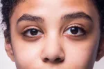 Ojos de una niña afectada por el síndrome de Turner