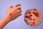 Pacientes con fibromialgia o artritis podrían tener Lyme sin diagnosticar Picadura de una garrapata