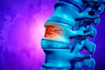 Las fracturas vertebrales por osteoporosis, peligrosa epidemia en aumento Rotura de una vértebra a causa de la osteoporosis