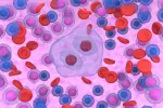 Una inmunoterapia para el linfoma de Hodgkin logra una supervivencia del 92% Ilustración 3D de una celda Reed-Sternberg del linfoma de Hodgkin