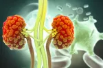 Fármacos contra la diabetes retrasan la progresión de la enfermedad renal Ilustración de unos riñones enfermos