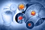 Españoles presentan impactantes avances en el tratamiento del cáncer de hígado Infografía de un carcinoma hepático